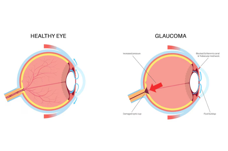 Glaucoma